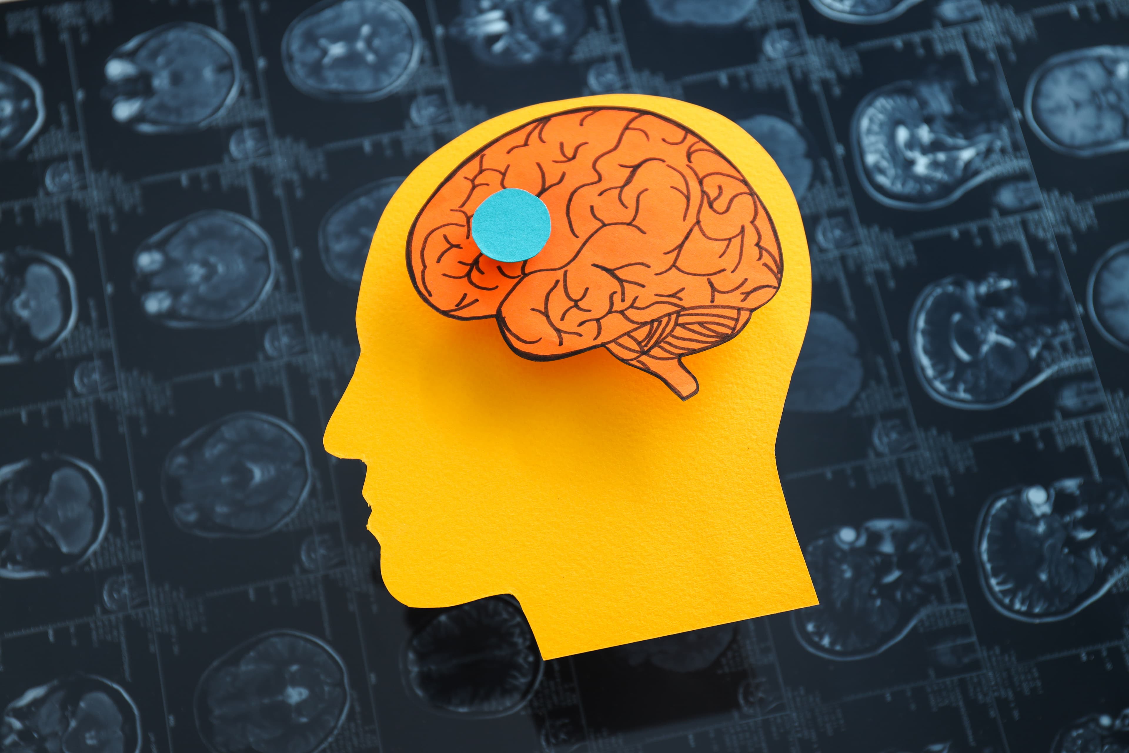 Paper cutout silhouette of a human head with a hand-drawn brain and a blue dot, layered over MRI scan images.