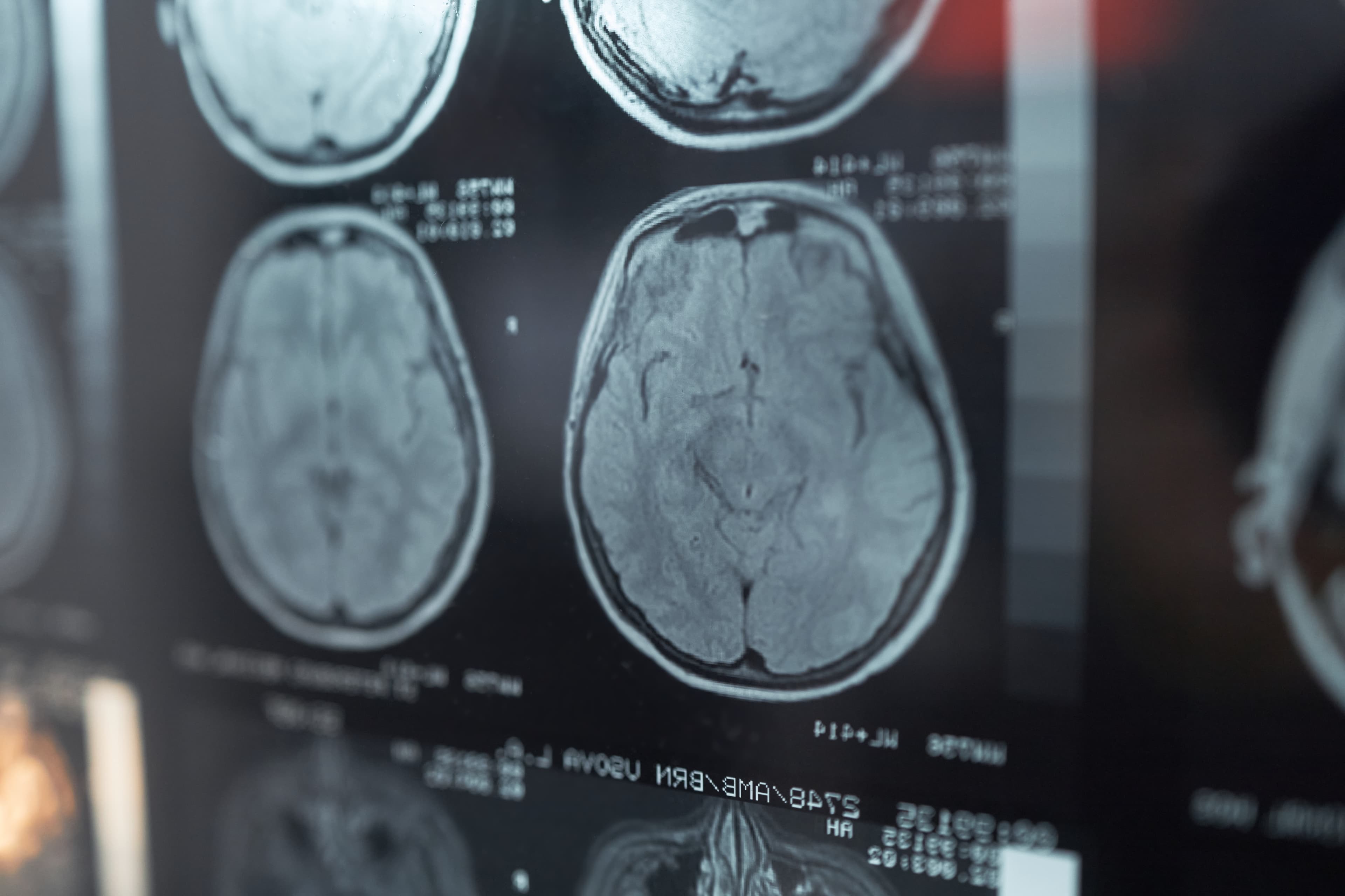 Multiple MRI brain scan slices displayed on a light board in a clinical setting.